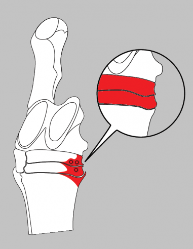 Fers à cheval aluminium - ACR 2150 - Fer asymétrique postérieur